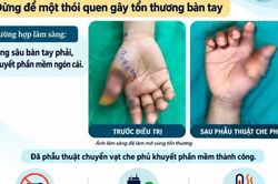 Bệnh nhân bỏng sâu bàn tay do điện thoại nổ khi sạc