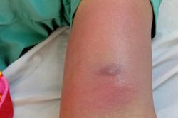 Giun rồng chui dưới da sau nhiều ngày đi rừng uống nước suối