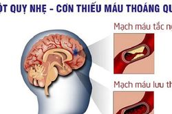 5 dấu hiệu nhận biết sớm cơn thiếu máu não thoáng qua