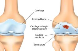 Phát hiện thuốc chống động kinh có thể giúp phục hồi sụn khớp