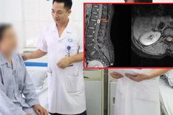 Đau lưng đến mất ngủ, người phụ nữ 39 tuổi đi khám phát hiện u tủy