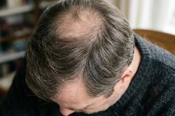Rụng tóc nên bổ sung sắt, kẽm hay biotin?