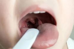 Vi&ecirc;m mũi họng k&eacute;o d&agrave;i ảnh hưởng g&igrave; đến sức khỏe trẻ?