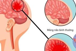 Khuyến c&aacute;o người d&acirc;n chủ động ph&ograve;ng ngừa bệnh nhiễm tr&ugrave;ng do n&atilde;o m&ocirc; cầu