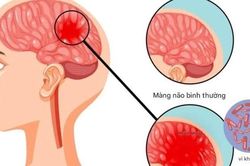 Bệnh n&atilde;o m&ocirc; cầu xuất hiện trong trường học: Những dấu hiệu phụ huynh kh&ocirc;ng thể bỏ qua