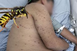 Người đ&agrave;n &ocirc;ng 62 tuổi su&yacute;t chết v&igrave; bị ong đốt 300 nốt