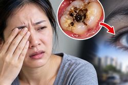 Người phụ nữ 35 tuổi su&yacute;t mất thị lực v&igrave; ổ s&acirc;u răng l&acirc;u năm