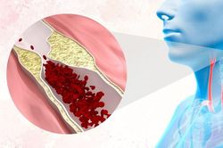 Hẹp động mạch cảnh c&oacute; thể &acirc;m thầm b&aacute;o trước một cơn đột quỵ