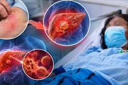 Tưởng dị ứng hải sản, người phụ nữ 45 tuổi b&agrave;ng ho&agrave;ng được ph&aacute;t hiện mắc ung thư gan nặng