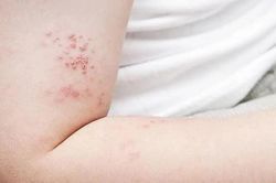 B&aacute;c sĩ tại nh&agrave; Nhận biết v&agrave; điều trị tổn thương do zona thần kinh