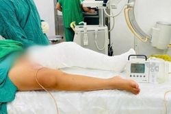 Phẫu thuật giải cứu cẳng chân bị co rút nặng do sẹo bỏng cho bé 9 tuổi