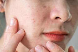 Nâng niu làn da: Cảnh giác với những 'liệu pháp' trên mạng xã hội