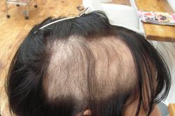 Thích nhổ tóc, nhổ lông vùng kín, dấu hiệu bệnh tâm thần