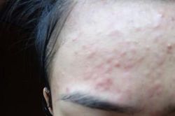 Mặt 'nở hoa' vì tin xông hơi bằng lá tía tô