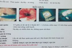 Hóc dị vật thực quản vì... uống thuốc
