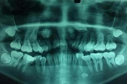 14 tuổi vẫn còn răng sữa, phát hiện hàng chục chiếc răng nhỏ