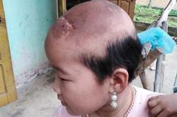 Số phận đáng thương của bé gái 3 lần phẫu thuật u não ác tính