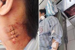 Bệnh viện Bạch Mai trả lời về tố cáo mổ nhầm gây biến chứng