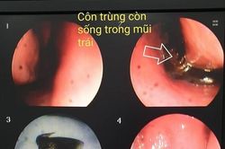Bác sĩ gắp ra từ mũi nữ bệnh nhân một con bướm nhỏ còn giãy dụa