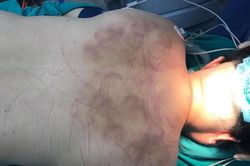 Liệt hai chân vì đi giác hơi, nắn bóp cổ gáy