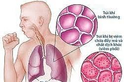 Viêm phổi - nguyên nhân tử vong hàng đầu trong các bệnh về đường hô hấp
