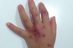 Gia đình tá hỏa vì lý do bé trai 13 tuổi mắc bệnh giang mai