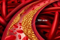 Phòng chống máu nhiễm mỡ