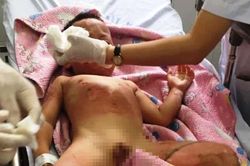 Ba trẻ mầm non bị bỏng khi tham gia học kỹ năng phòng, chống cháy nổ