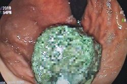 Thường xuyên uống trà sữa thay cơm, chàng trai trẻ phát hiện thứ kinh hoàng trong bụng