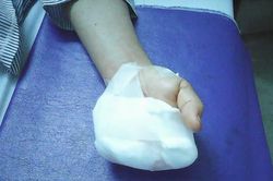 Bất cẩn khi xay thịt, một phụ nữ mất 4 ngón tay
