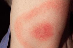 Những dấu hiệu nguy hiểm khi bị côn trùng cắn