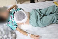 Ngực lở loét, hoại tử sau khi chữa bệnh ở thầy lang
