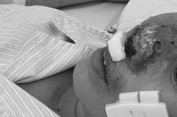 Người phụ nữ ở Hà Nội bị 'vi khuẩn ăn thịt người' ăn mũi