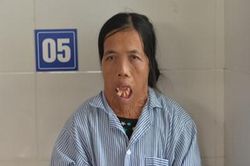 Bệnh viện Bỏng Quốc gia phẫu thuật thành công cho bệnh nhân 48 năm không ngậm được miệng