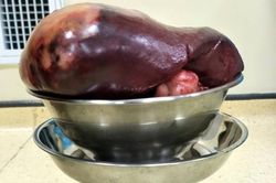 Kinh hoàng: Cắt khối u lách khổng lồ cho bệnh nhân nữ