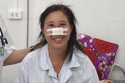 Người phụ nữ bị vi khuẩn Whitmore 'ăn' cánh mũi được xuất viện