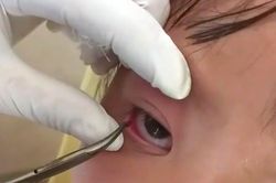 Khám mắt cho bé gái người Mông, bác sĩ phát hiện và gắp ra một con vắt