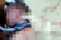 Một trẻ sơ sinh bị dây rốn quấn 3 vòng quanh cổ chào đời an toàn