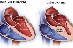 Bộ Y tế chưa ghi nhận chủng 'virus lạ gây viêm cơ tim'