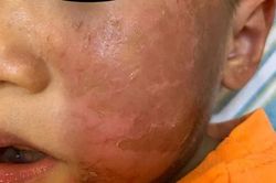 Khiếp hãi bé 4 tuổi bỏng rộp da mặt vì đeo mặt nạ hóa trang Halloween