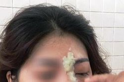 Cô gái 21 tuổi mù mắt sau khi tiêm filler nâng mũi