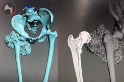 Kỳ tích y học Việt Nam: Thay xương đùi bằng xương nhân tạo in 3D