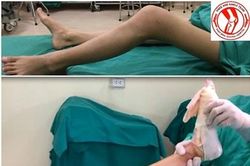 Lần đầu tiên thay khớp gối ở trẻ em tại Việt Nam
