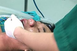 Bác sĩ khuyên khi chảy máu mũi ồ ạt phải làm gì?