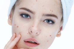 Tạm biệt mụn với những thực phẩm quen thuộc hằng ngày