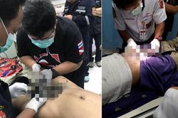 Chàng trai phải cắt bỏ của quý vì nghịch dại để thỏa mãn bản thân