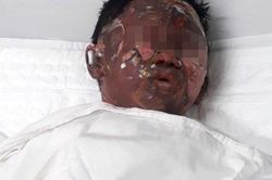 Tình hình sức khỏe của cháu bé bị dì ruột châm lửa đốt ở Bà Rịa - Vũng Tàu