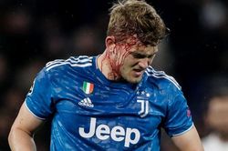 De Ligt đổ máu trong thất bại của Juventus