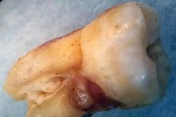 Giật mình khi thấy răng người lạ trong đồ ăn ở nhà hàng