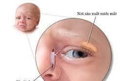Chảy nước mắt sống là bệnh gì?